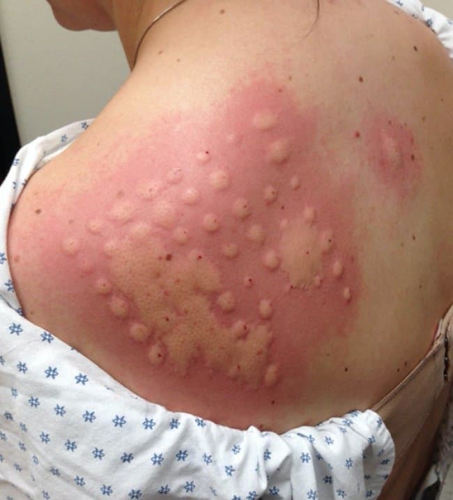 alergias a antialérgicos